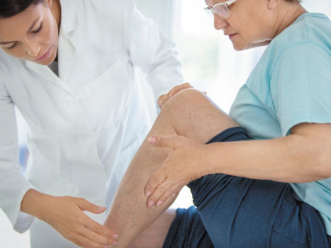 What Are Your Options When Treating Varicose Veins