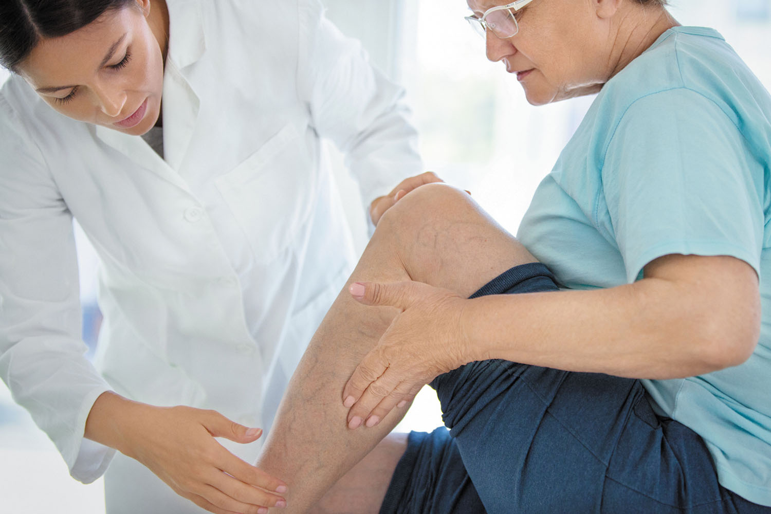 What Are Your Options When Treating Varicose Veins